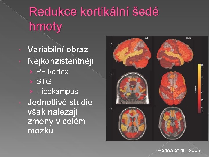 Redukce kortikální šedé hmoty Variabilní obraz Nejkonzistentněji › PF kortex › STG › Hipokampus