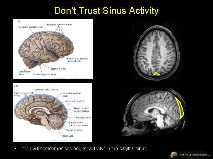 Don’t Trust Sinus Activity • You will sometimes see bogus “activity” in the sagittal
