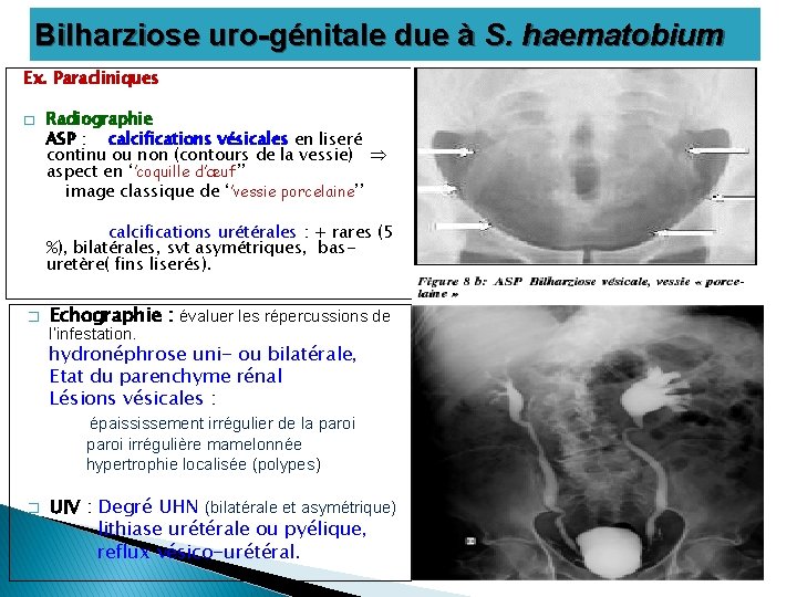 Bilharziose uro-génitale due à S. haematobium Ex. Paracliniques � Radiographie ASP : calcifications vésicales