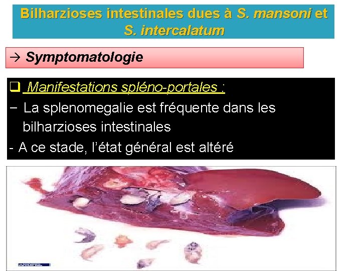 Bilharzioses intestinales dues à S. mansoni et S. intercalatum Symptomatologie q Manifestations spléno-portales :