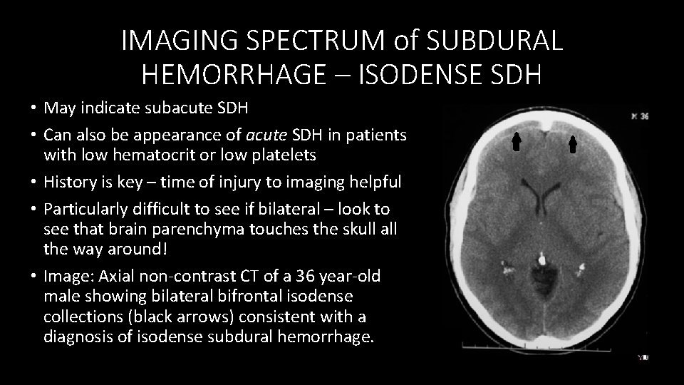 IMAGING SPECTRUM of SUBDURAL HEMORRHAGE – ISODENSE SDH • May indicate subacute SDH •