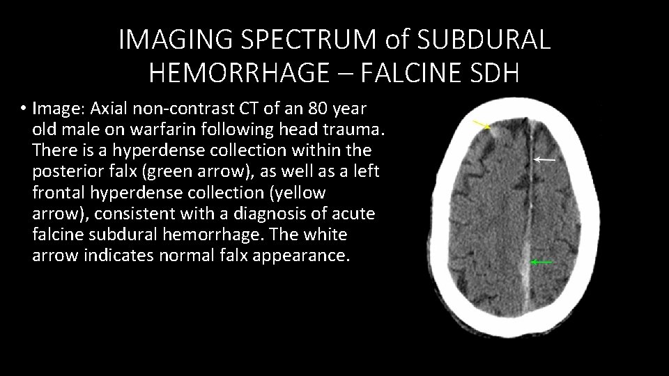 IMAGING SPECTRUM of SUBDURAL HEMORRHAGE – FALCINE SDH • Image: Axial non‐contrast CT of