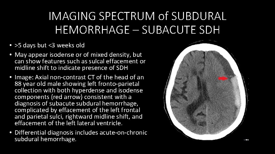 IMAGING SPECTRUM of SUBDURAL HEMORRHAGE – SUBACUTE SDH • >5 days but <3 weeks