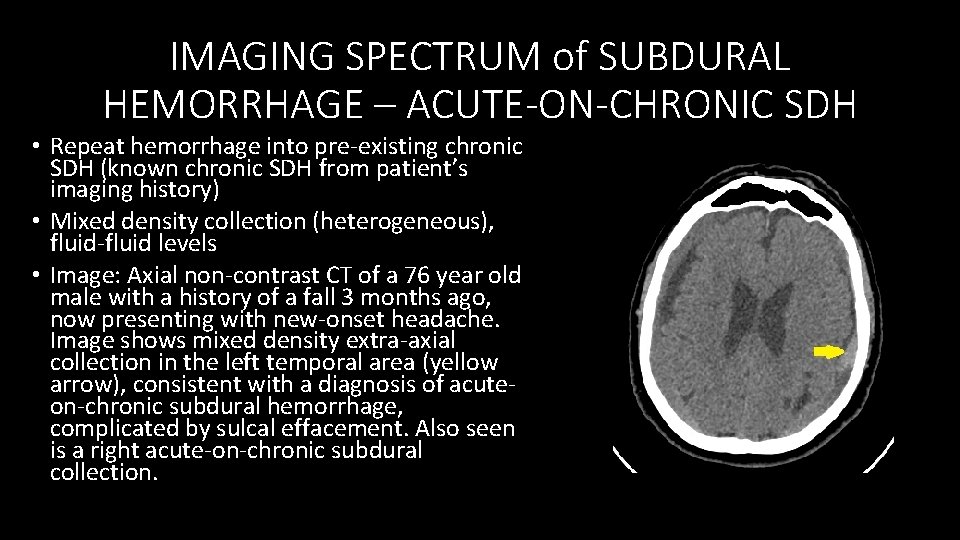 IMAGING SPECTRUM of SUBDURAL HEMORRHAGE – ACUTE-ON-CHRONIC SDH • Repeat hemorrhage into pre‐existing chronic