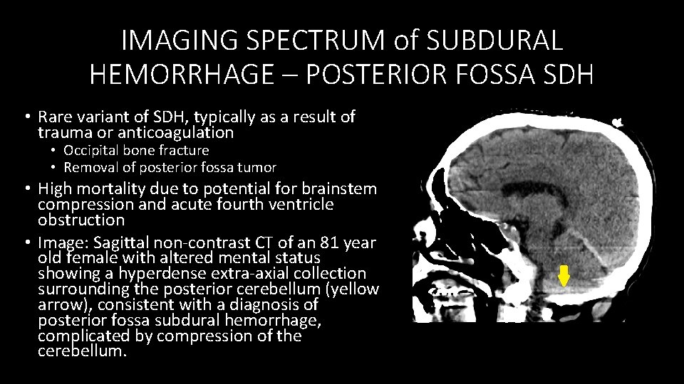 IMAGING SPECTRUM of SUBDURAL HEMORRHAGE – POSTERIOR FOSSA SDH • Rare variant of SDH,