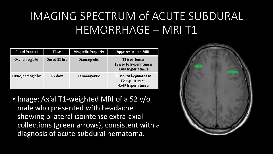 IMAGING SPECTRUM of ACUTE SUBDURAL HEMORRHAGE – MRI T 1 Blood Product Time Magnetic