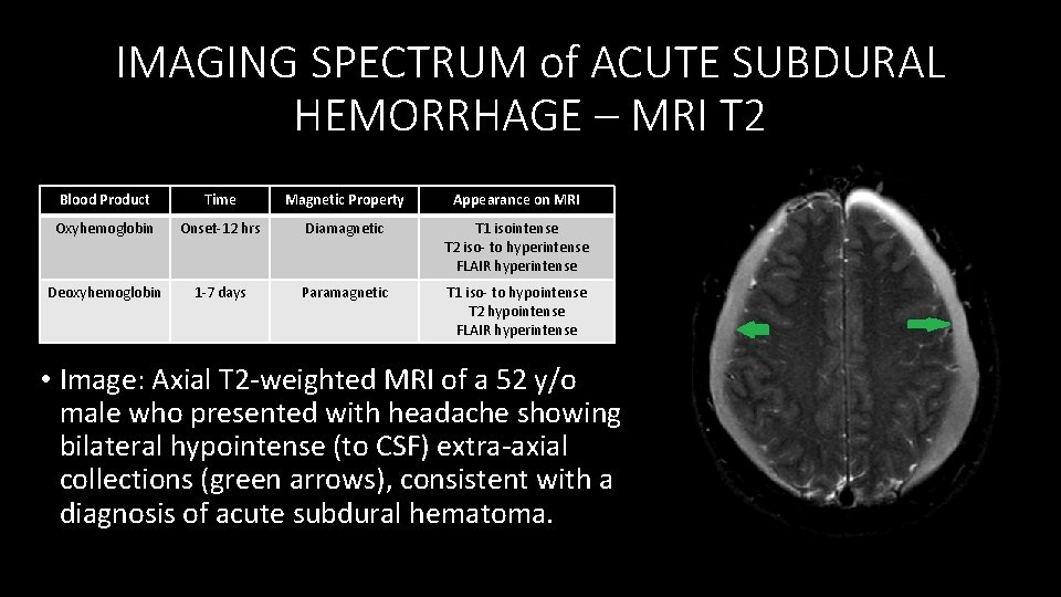IMAGING SPECTRUM of ACUTE SUBDURAL HEMORRHAGE – MRI T 2 Blood Product Time Magnetic
