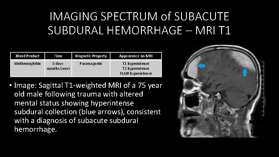 IMAGING SPECTRUM of SUBACUTE SUBDURAL HEMORRHAGE – MRI T 1 Blood Product Time Magnetic