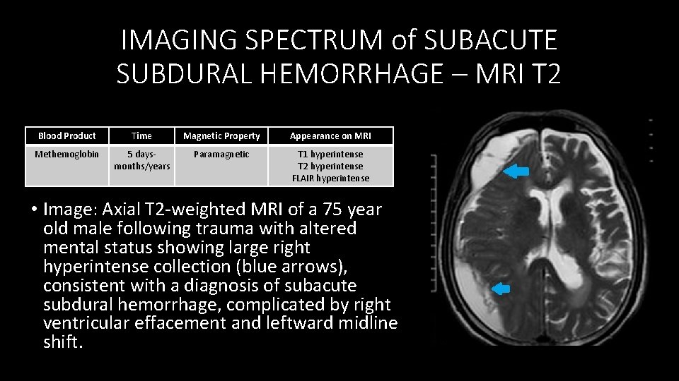 IMAGING SPECTRUM of SUBACUTE SUBDURAL HEMORRHAGE – MRI T 2 Blood Product Time Magnetic