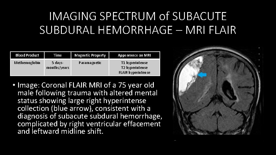 IMAGING SPECTRUM of SUBACUTE SUBDURAL HEMORRHAGE – MRI FLAIR Blood Product Time Magnetic Property