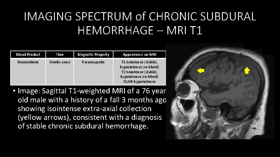 IMAGING SPECTRUM of CHRONIC SUBDURAL HEMORRHAGE – MRI T 1 Blood Product Time Magnetic