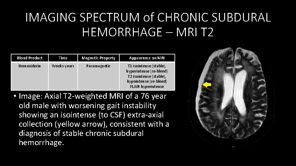 IMAGING SPECTRUM of CHRONIC SUBDURAL HEMORRHAGE – MRI T 2 Blood Product Time Magnetic