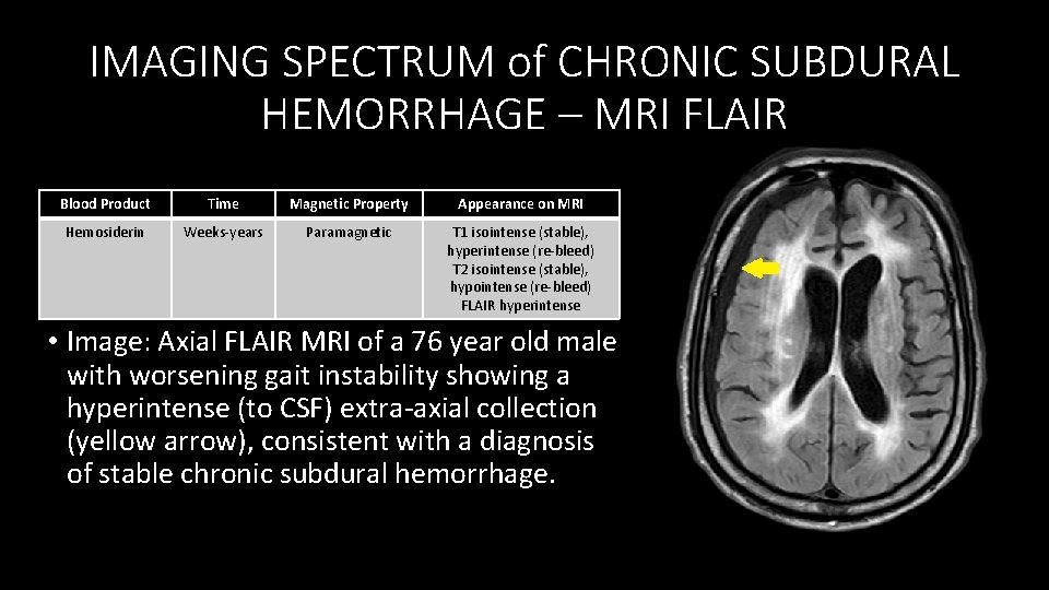 IMAGING SPECTRUM of CHRONIC SUBDURAL HEMORRHAGE – MRI FLAIR Blood Product Time Magnetic Property