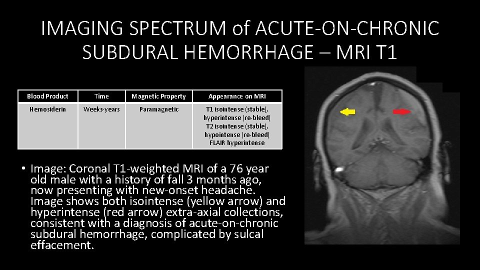IMAGING SPECTRUM of ACUTE-ON-CHRONIC SUBDURAL HEMORRHAGE – MRI T 1 Blood Product Time Magnetic