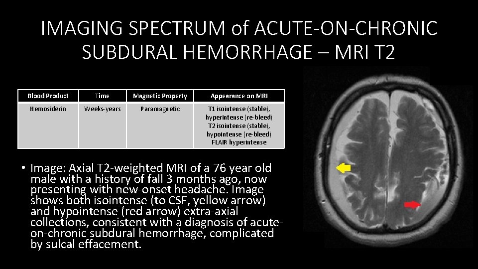 IMAGING SPECTRUM of ACUTE-ON-CHRONIC SUBDURAL HEMORRHAGE – MRI T 2 Blood Product Time Magnetic