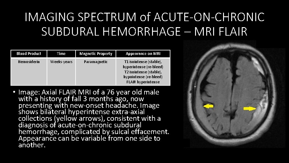 IMAGING SPECTRUM of ACUTE-ON-CHRONIC SUBDURAL HEMORRHAGE – MRI FLAIR  Blood Product Hemosiderin Time