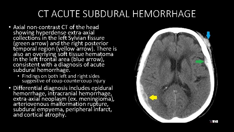 CT ACUTE SUBDURAL HEMORRHAGE • Axial non‐contrast CT of the head showing hyperdense extra‐axial