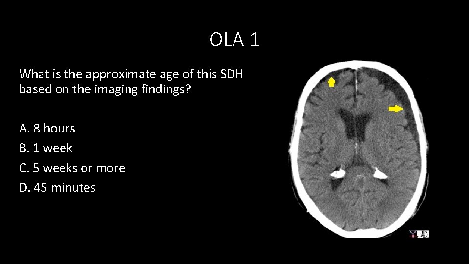 OLA 1 What is the approximate age of this SDH based on the imaging