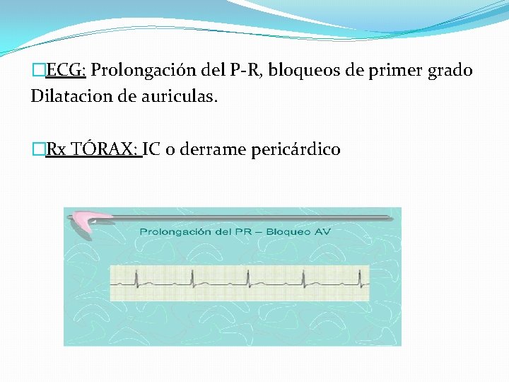 �ECG: Prolongación del P-R, bloqueos de primer grado Dilatacion de auriculas. �Rx TÓRAX: IC