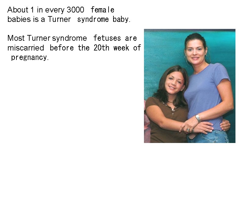 About 1 in every 3000 female babies is a Turner syndrome baby. Most Turner