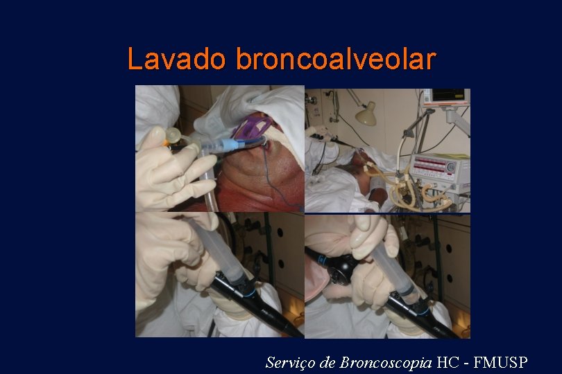 Lavado broncoalveolar Serviço de Broncoscopia HC - FMUSP 