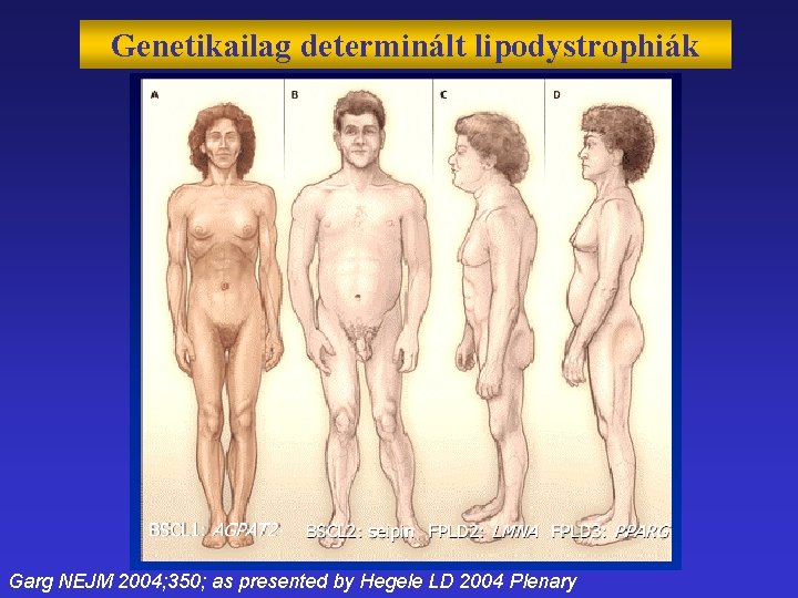 Genetikailag determinált lipodystrophiák Garg NEJM 2004; 350; as presented by Hegele LD 2004 Plenary