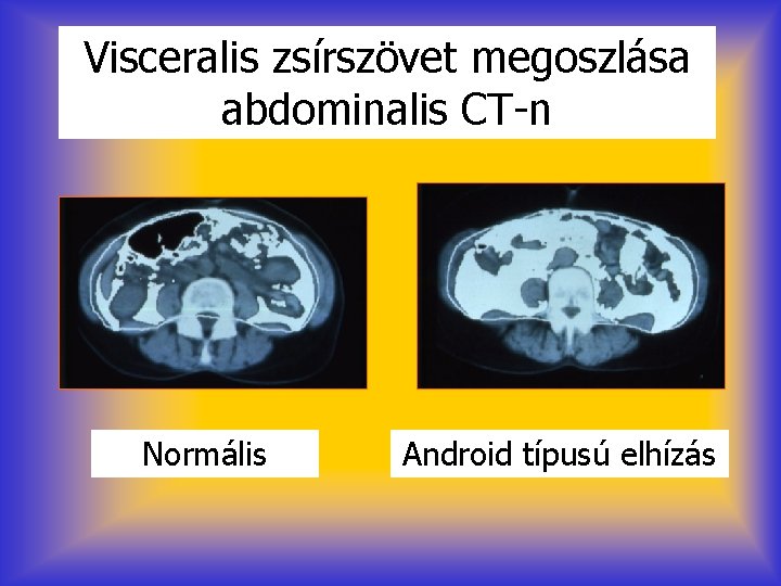 Visceralis zsírszövet megoszlása abdominalis CT-n Normális Android típusú elhízás 