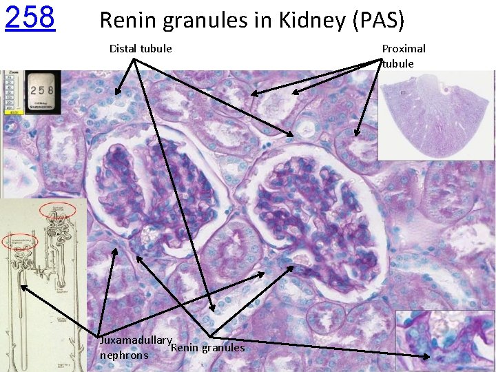 258 Renin granules in Kidney (PAS) Distal tubule Juxamadullary Renin granules nephrons Proximal tubule