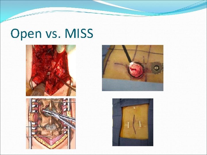 Open vs. MISS 