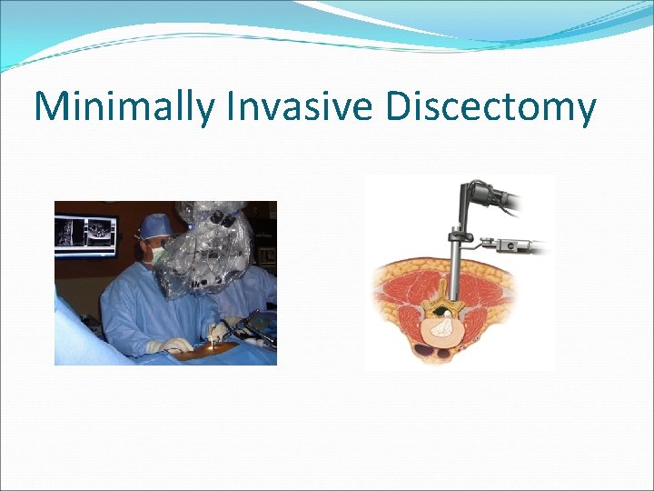 Minimally Invasive Discectomy 