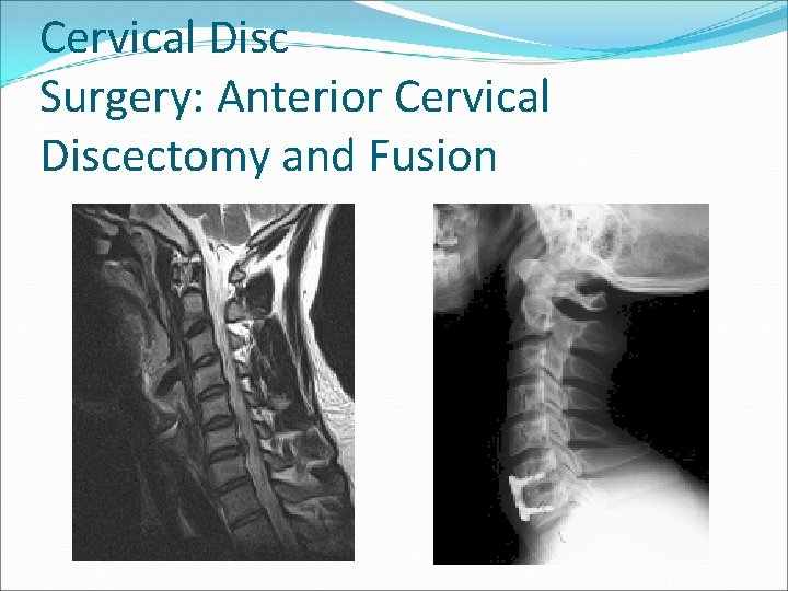 Cervical Disc Surgery: Anterior Cervical Discectomy and Fusion 