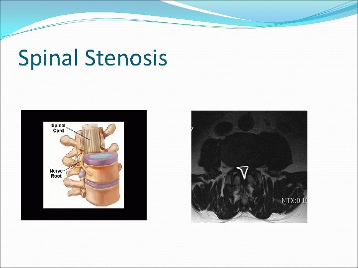 Spinal Stenosis 