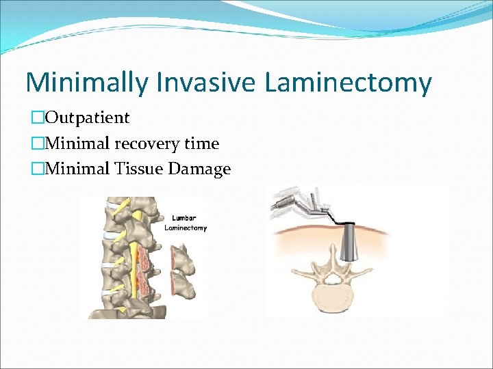 Minimally Invasive Laminectomy �Outpatient �Minimal recovery time �Minimal Tissue Damage 