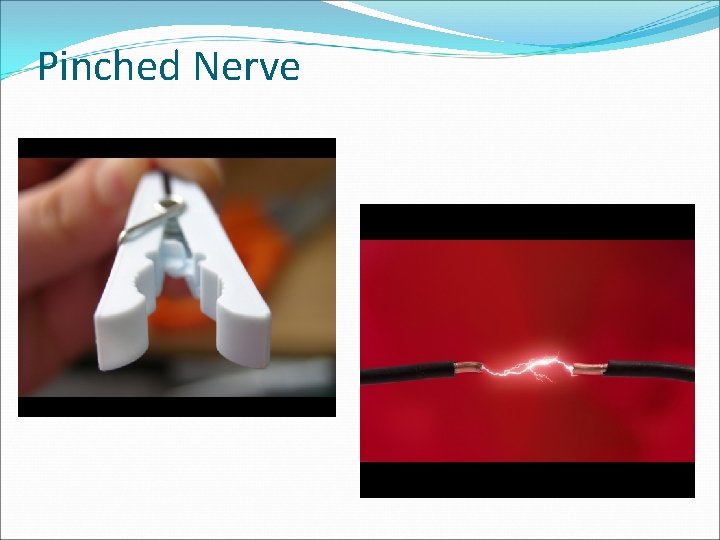 Pinched Nerve 