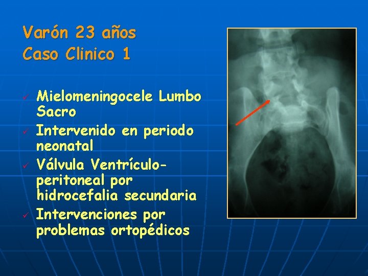 Varón 23 años Caso Clinico 1 ü ü Mielomeningocele Lumbo Sacro Intervenido en periodo