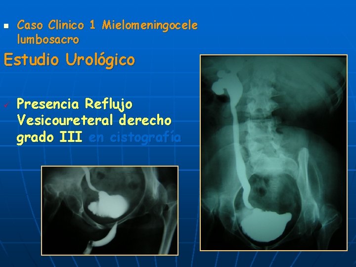 n Caso Clinico 1 Mielomeningocele lumbosacro Estudio Urológico ü Presencia Reflujo Vesicoureteral derecho grado