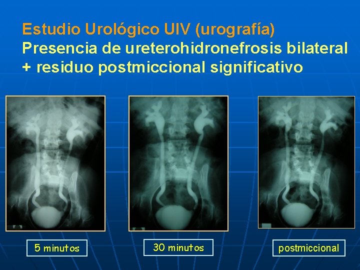 Estudio Urológico UIV (urografía) Presencia de ureterohidronefrosis bilateral + residuo postmiccional significativo 5 minutos