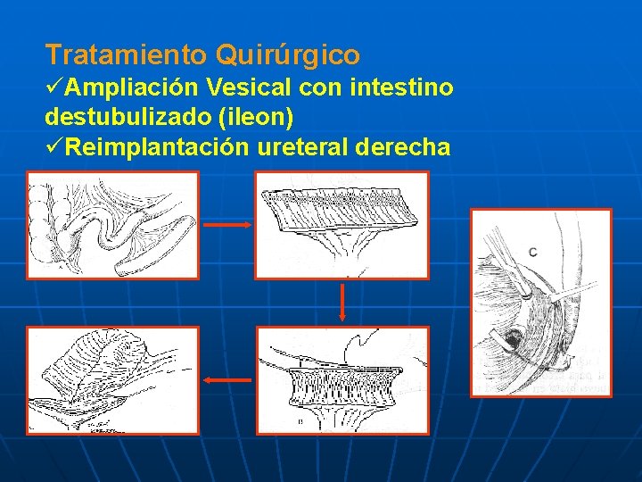 Tratamiento Quirúrgico üAmpliación Vesical con intestino destubulizado (ileon) üReimplantación ureteral derecha 