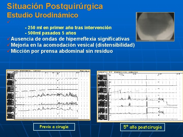Situación Postquirúrgica Estudio Urodinámico üMejoría en cuanto al la capacidad vesical - 250 ml