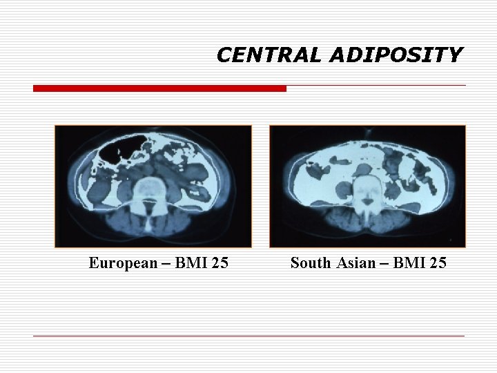 CENTRAL ADIPOSITY European – BMI 25 South Asian – BMI 25 