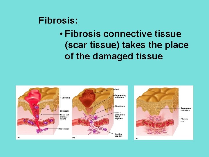 Fibrosis: • Fibrosis connective tissue (scar tissue) takes the place of the damaged tissue