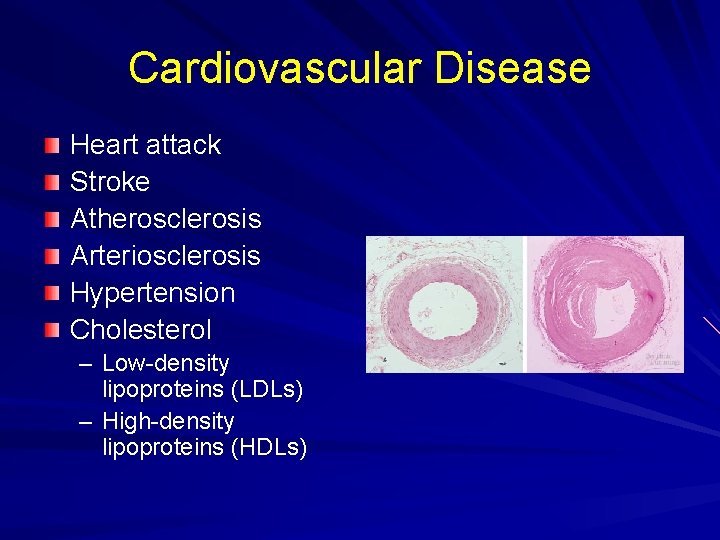 Cardiovascular Disease Heart attack Stroke Atherosclerosis Arteriosclerosis Hypertension Cholesterol – Low-density lipoproteins (LDLs) –