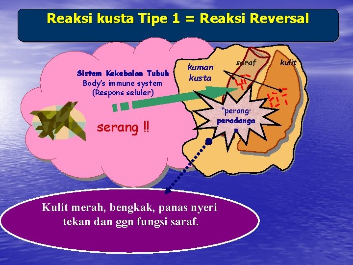 Reaksi kusta Tipe 1 = Reaksi Reversal Sistem Kekebalan Tubuh Body’s immune system (Respons