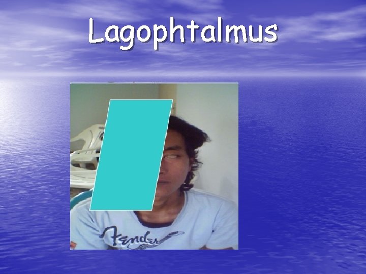Lagophtalmus 