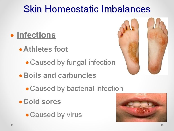 Skin Homeostatic Imbalances · Infections · Athletes foot · Caused by fungal infection ·
