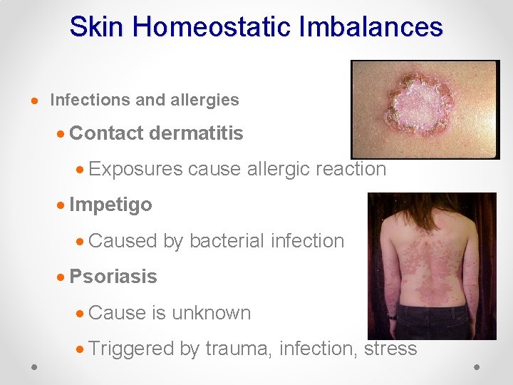 Skin Homeostatic Imbalances · Infections and allergies · Contact dermatitis · Exposures cause allergic