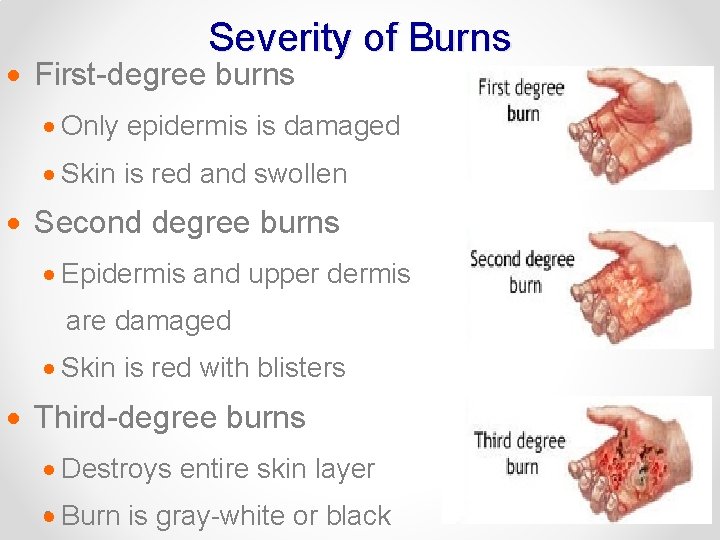 Severity of Burns · First-degree burns · Only epidermis is damaged · Skin is