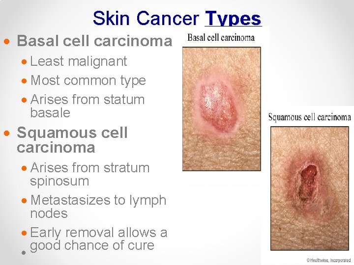 Skin Cancer Types · Basal cell carcinoma · Least malignant · Most common type