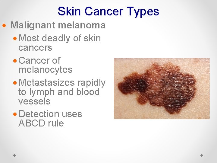 Skin Cancer Types · Malignant melanoma · Most deadly of skin cancers · Cancer