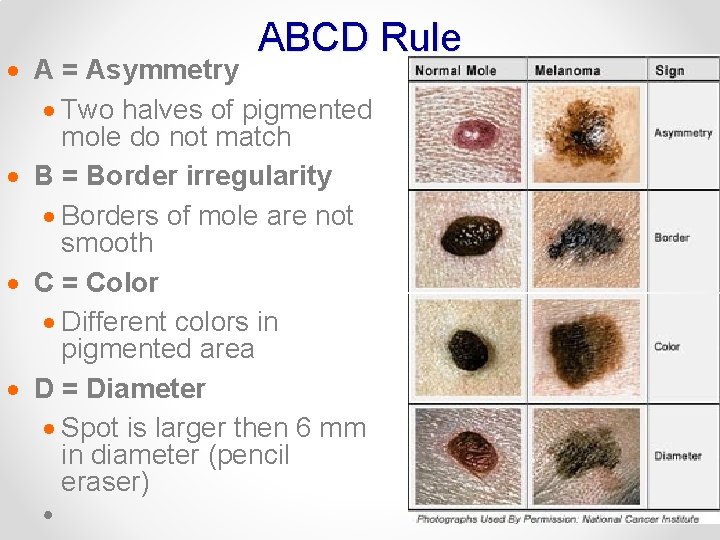 ABCD Rule · A = Asymmetry · Two halves of pigmented mole do not